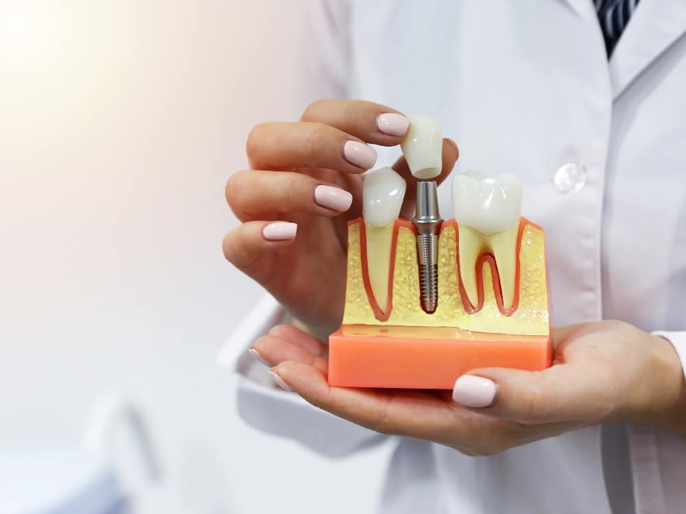 O que é um Implante Dentário?