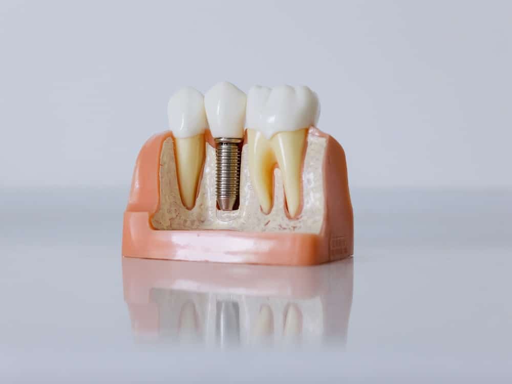 Quais as desvantagens do Implante Dentário?