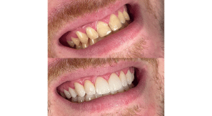 Lentes de Contato em Blumenau SC - Odontologia Premier