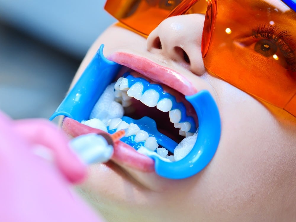 O clareamento dental melhora a estética dos dentes