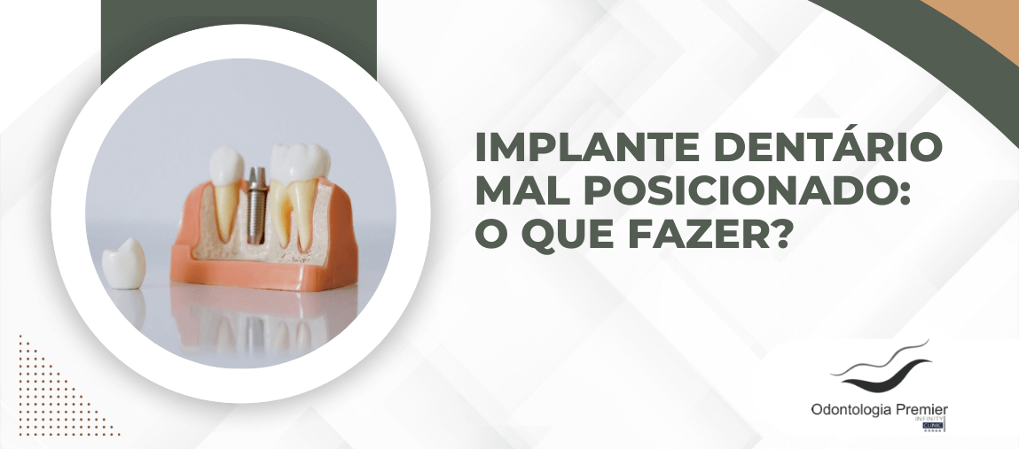 Implante dentário mal posicionado: o que fazer?