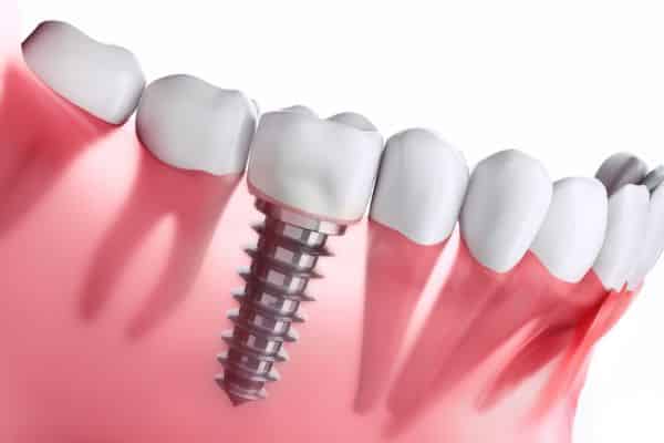 Instalação dos implantes no osso zigomático