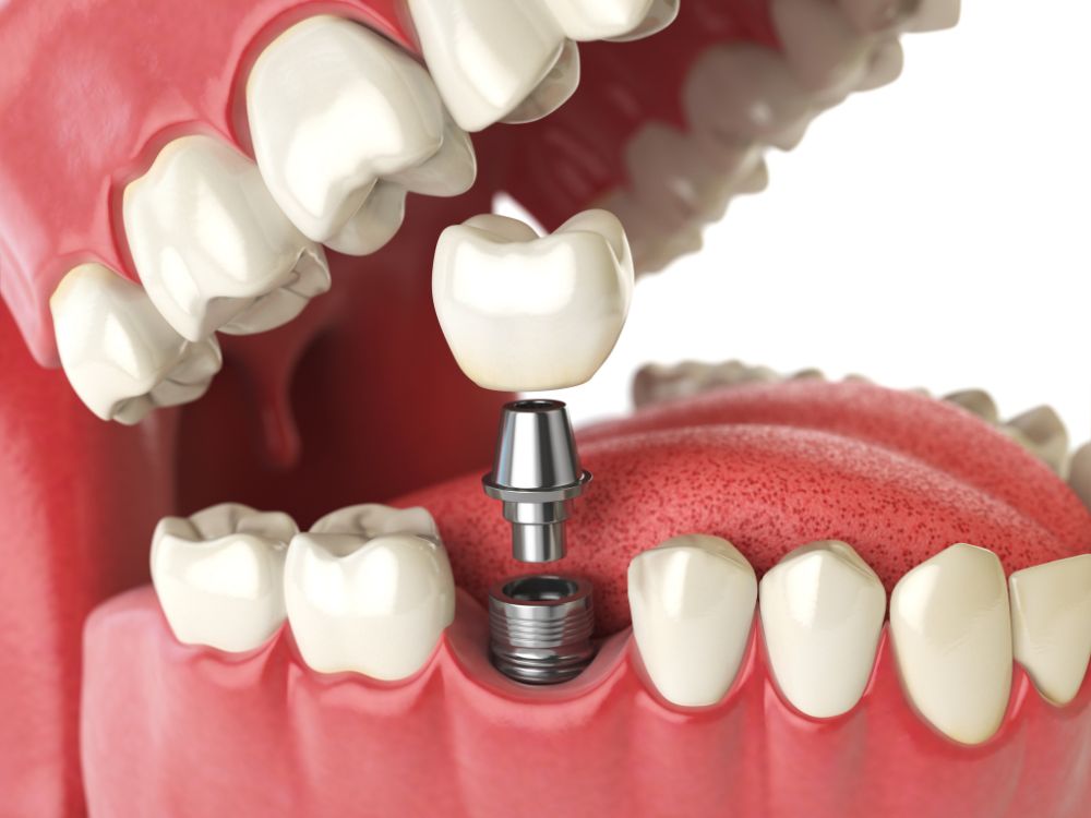Ilustração de prótese sendo fixada sobre implante dentário, representando técnica aplicada ao explicar O que é implante zigomático.
