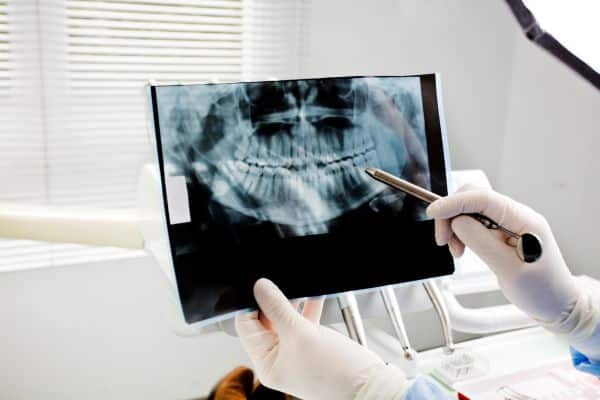 Profissional analisando radiografia panorâmica e apontando áreas da arcada dentária para avaliação relacionada ao Implante Zigomático.