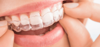 Invisalign em Blumenau