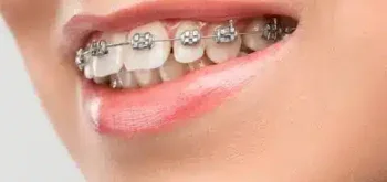 Ortodontia em Blumenau - Odontologia Premier